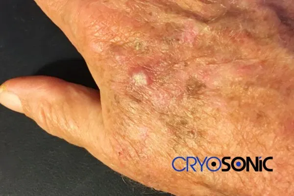 Book Your Actinic Keratosis removal Hartlepool treatment Today Hartlepool