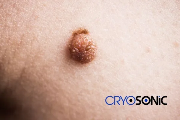 Are you looking for local Dermatofibroma Removal Bristol? Contact our team today in Hartlepool
