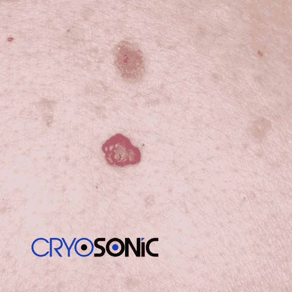 Looking for pain free cherry angioma removal treatment Hartlepool? Call our team today! Hartlepool