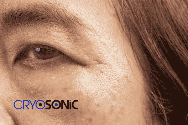 Start age spots removal Hartlepool treatment today! Call our team now! Hartlepool