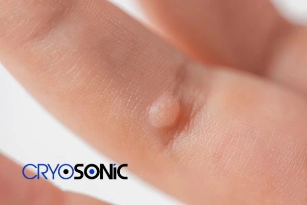 Contact Cryosonic today to learn more about us Hartlepool now! Hartlepool