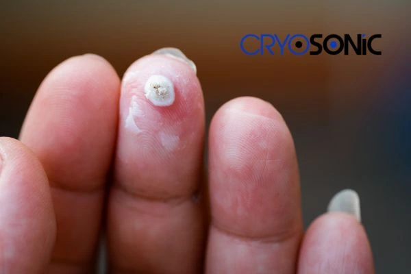 Learn more about us Hartlepool at Cryosonic. Book in today! Hartlepool