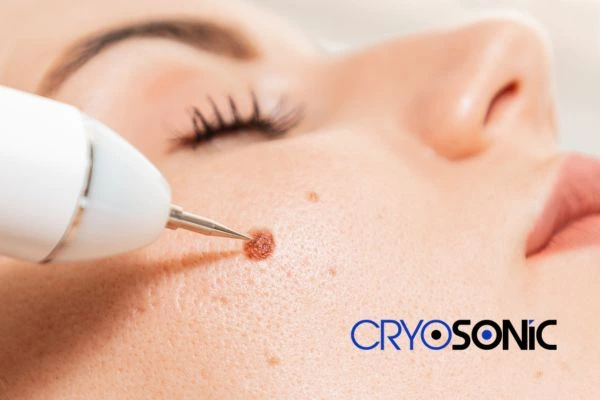 why choose us at Cryosonic for blemish removal? Find out more now Hartlepool