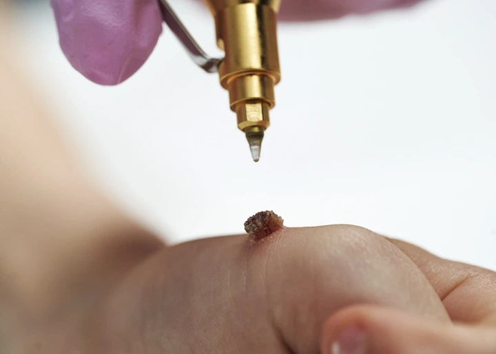 Cryopen For Children Bristol Hartlepool