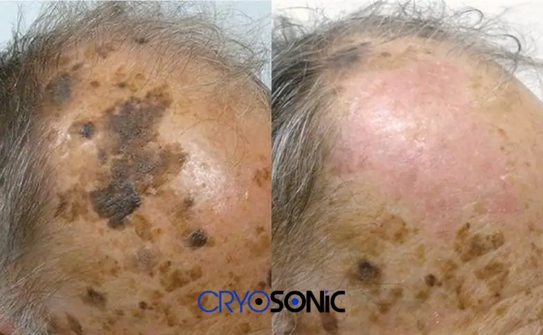 Seborrhoeic Keratosis Removal before and after Hartlepool