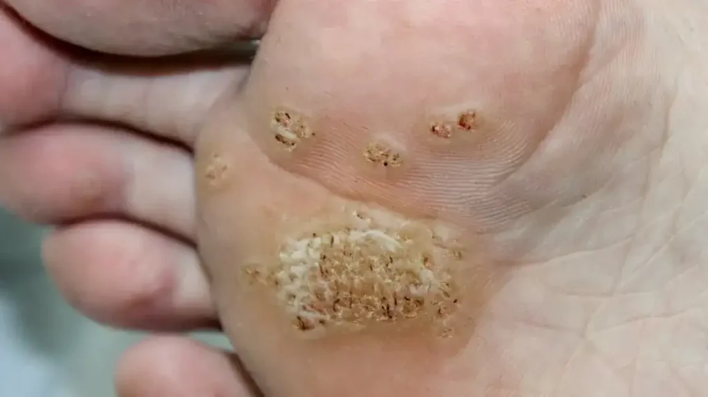Secure Your Wart Removal Appointment with One Click Hartlepool