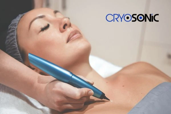 Cryosonic lesion removal prices book today! Hartlepool