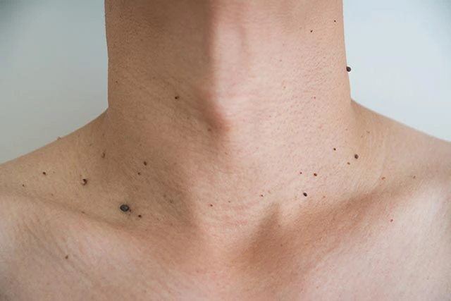 What to Avoid After Benign Mole Treatment in Hartlepool Hartlepool