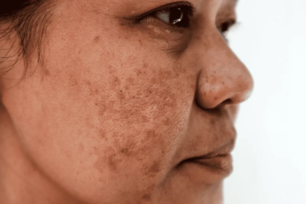Aftercare Advice for Sun Damage Treatment Hartlepool