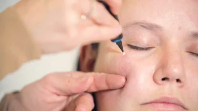 Aftercare Advice Following Milia Removal in Hartlepool