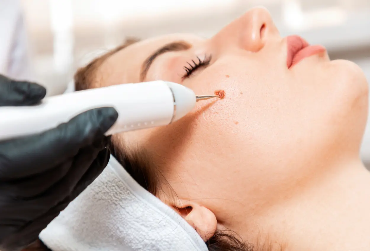 Frequently Asked Questions About Multiple Cryotherapy Treatments Hartlepool