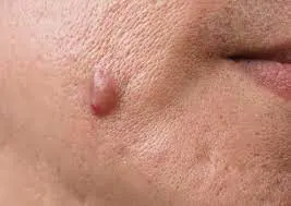 Skin Tags Recovery Time and Skin Healing Expectations Hartlepool