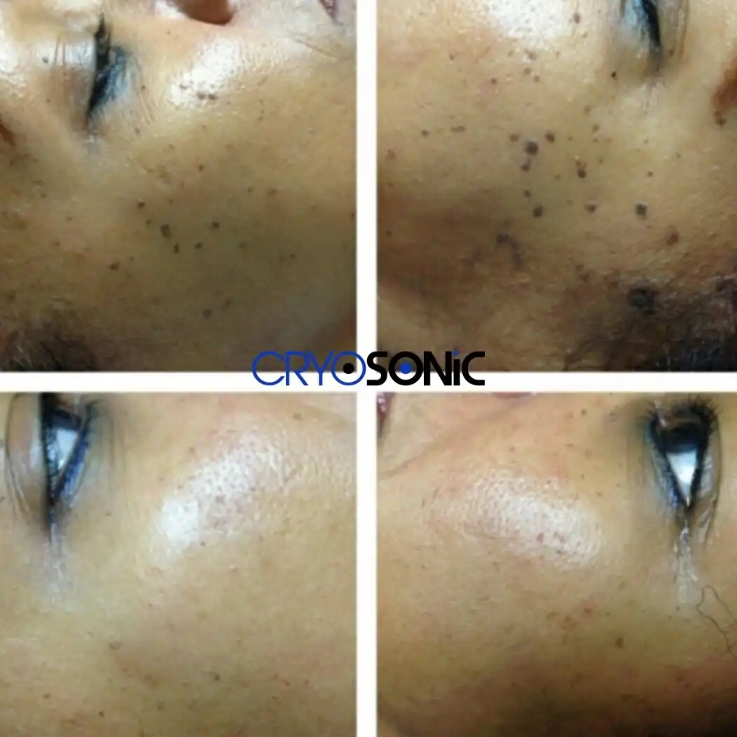 Why Skin Shows Pigmentation After Treatment Hartlepool