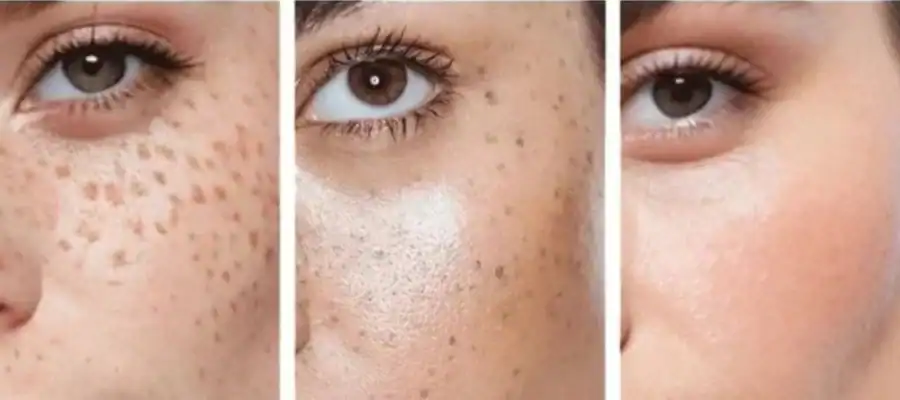 Ephelides Removal Results and Healing Timeline Hartlepool
