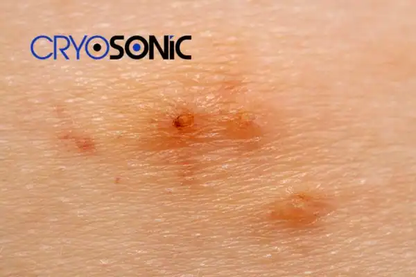 Image of Molluscum Contagiosum Treatment Hartlepool Hartlepool