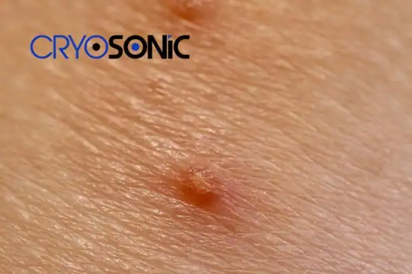 Molluscum Contagiosum Treatment Hartlepool Hartlepool