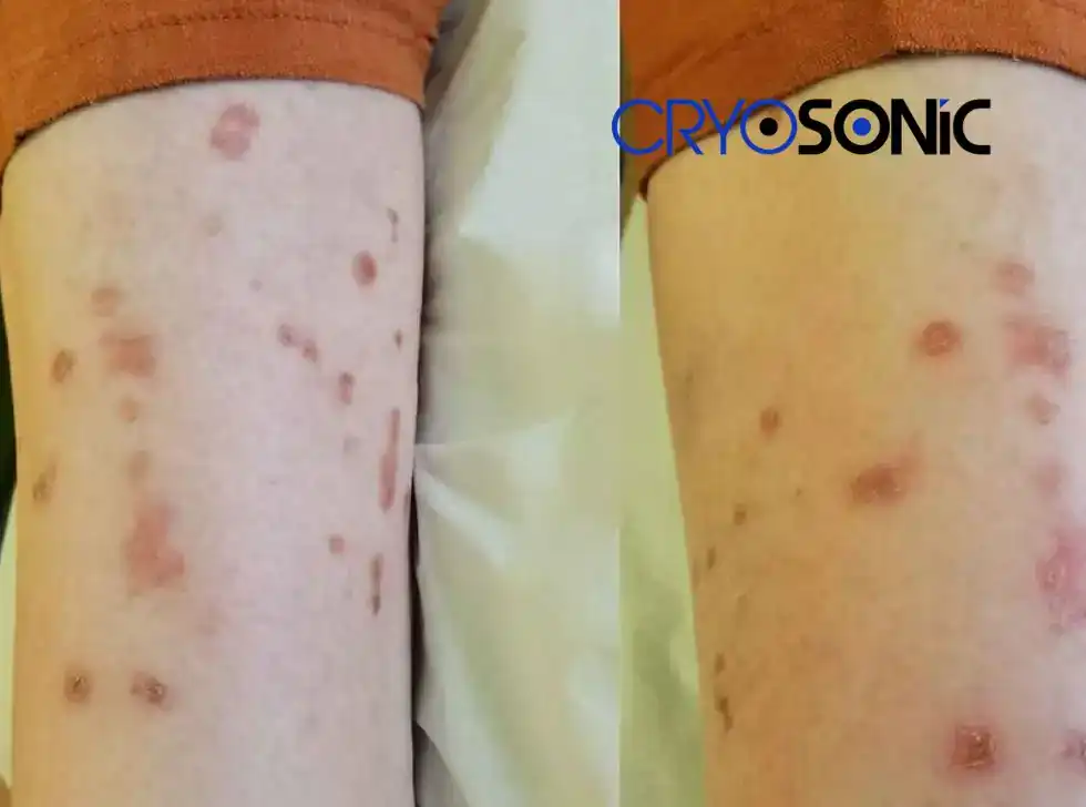 Recovery and Aftercare for Porokeratosis Treatment Hartlepool Hartlepool