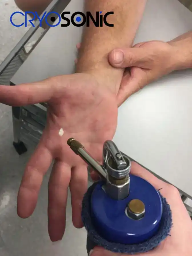 Temperature Differences: OTC vs Medical-Grade Cryotherapy Hartlepool